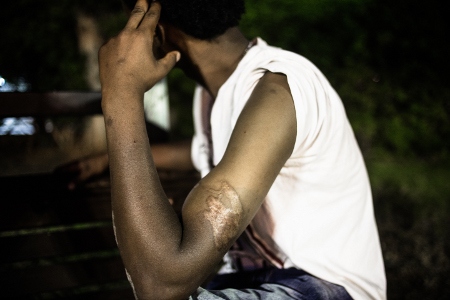 Merhawis armar bär spår av tortyren när smält plast droppades på huden. Han är en av tusentals eritreaner som har kidnappats i flyktingläger i östra Sudan.