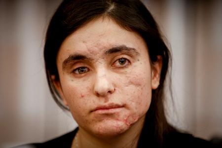  Lamiya Aji Bashar skadades svårt av en landmina under flykten från IS, och blev blind på ena ögat. 